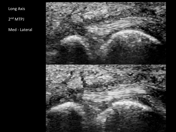 Figure 1 for case plantar plate of metatarsophalangeal joint ( RID3134 )